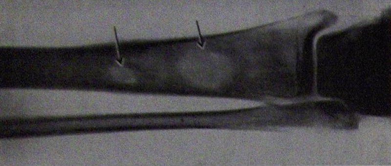 Системная красная волчанка острого течения: аваскулярные некрозы (обозначено стрелками) большеберцовой кости