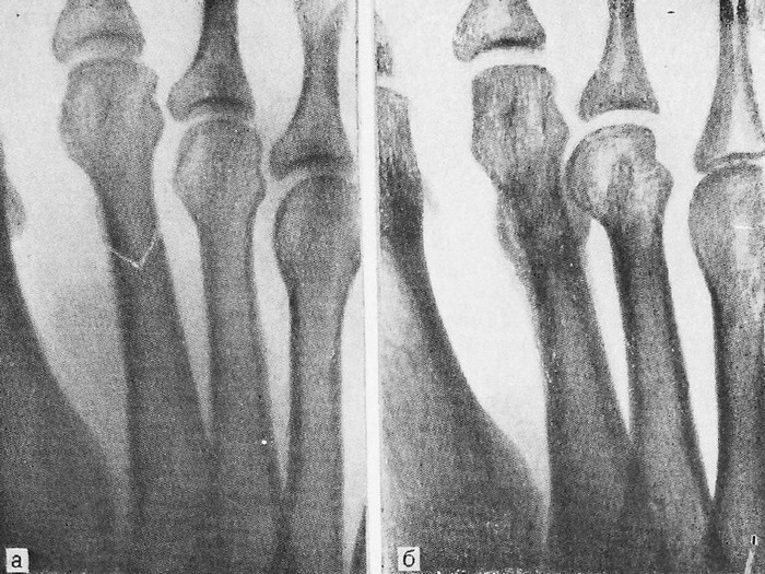 Болезнь Дойчлендера — патологическая функциональная перестройка плюсневой кости