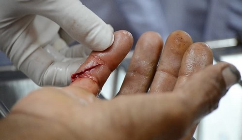 Резаная рана пальца
