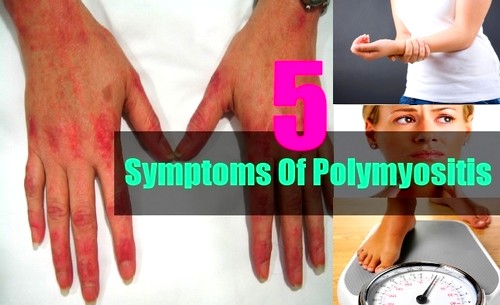 5 симптомов дерматомиозита (полимиозита)