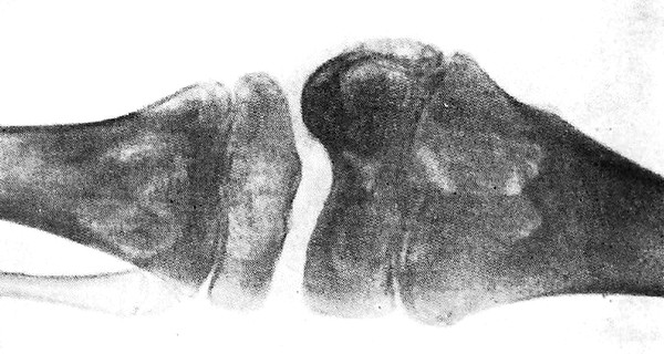 Громадные полости (каверны) в бедренной и большеберцовой костях