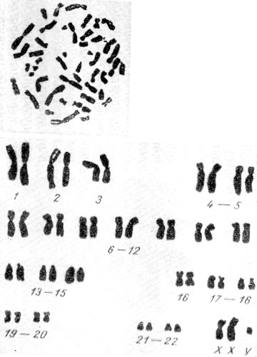 Кариотип 44A + XXY при синдроме Клайнфельтера