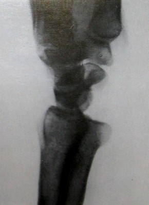 Ладонный вывих локтевой кости в запястье на боковом рентгеновском снимке
