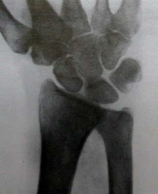 Ладонный вывих локтевой кости в запястье на прямом рентгеновском снимке