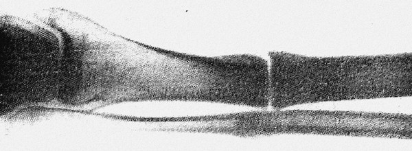 Ложный сустав (фото с рентгенограммы) в средней трети большеберцовой кости