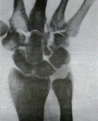 Рентгеновский снимок перелома крючковатой кости запястья