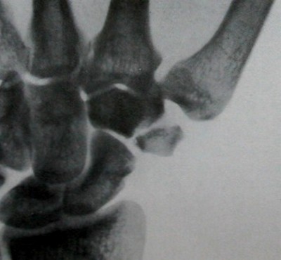Рентгеновский снимок в ладонной проекции перелома большой многогранной кости запястья