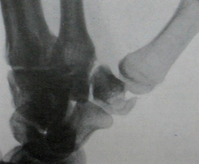 Рентгеновский снимок в косой проекции перелома большой многогранной кости запястья