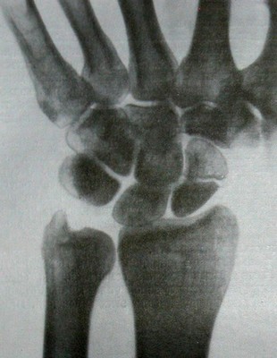 Снимок перелома ладьевидной кости после 6-недельной иммобилизации
