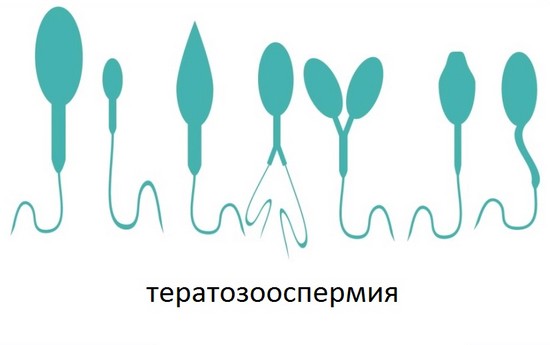 Тератозооспермия - уродливые формы сперматозоидов