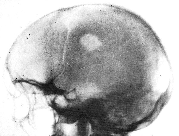 Эозинофильная гранулема черепа