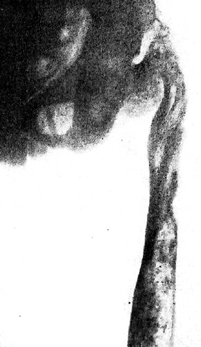 Фиброзная остеодисплазия. Фото рентгенограммы бедренной кости у ребенка 12 лет