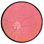 Вторичная атрофия зрительного нерва
