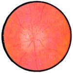 Застойный диск (сосок) зрительного нерва