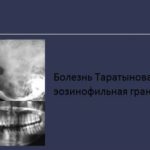 Болезнь Таратынова — эозинофильная гранулема