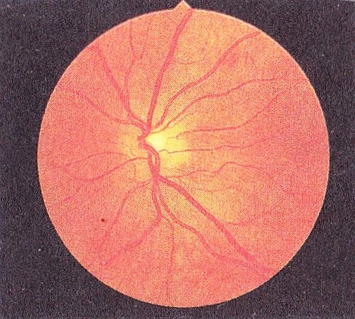 Базальная (непролиферативная) диабетическая ретинопатия