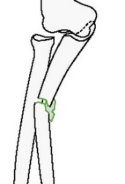 Клиновидный перелом локтевой кости, лучевая интактна