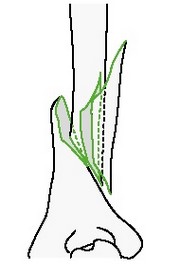 Клиновидный перелом плечевой кости со спиральным клином