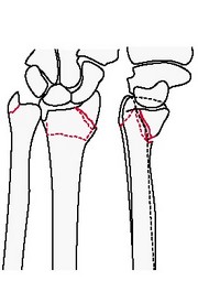Неполный внутрисуставной фронтальный перелом ладонного края (обратный Barton, Goyrand-Smith II) лучевой кости