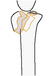 Неполный внутрисуставной фронтальный перелом тыльного края (Barton) лучевой кости