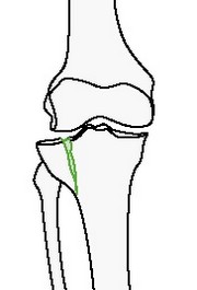 Неполный внутрисуставной перелом большеберцовой или малоберцовой костей отколом мыщелка