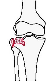 Неполный внутрисуставной перелом большеберцовой или малоберцовой костей с отколом мыщелка и с вдавливанием