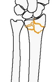 Полный внутрисуставной простой, метафизарный многооскольчатый перелом лучевой кости