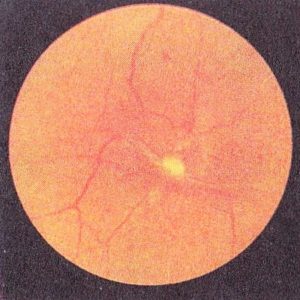 Пролиферативный диабетический ретинит