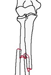 Простой перелом обеих костей предплечья