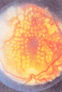 Результат лазерной фотокоагуляции обширной диабетической ретинопатии