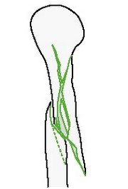 Сложный спиральный перелом плечевой кости