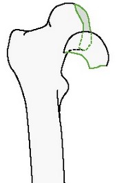 Внутрисуставной перелом головки бедренной кости по типу раскола