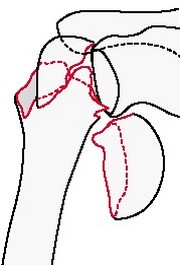 Внутрисуставной перелом плечевой кости с вывихом