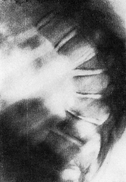 Болезнь Шейермана-Мау (фото рентгенограммы)