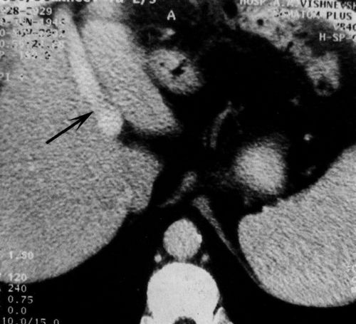 Фрагмент компьютерной томограммы больного циррозом печени (фото КТ)