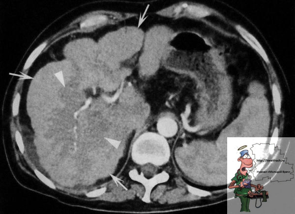 Компьютерная томограмма больного циррозом печени в конечной стадии развития заболевания (фото КТ)