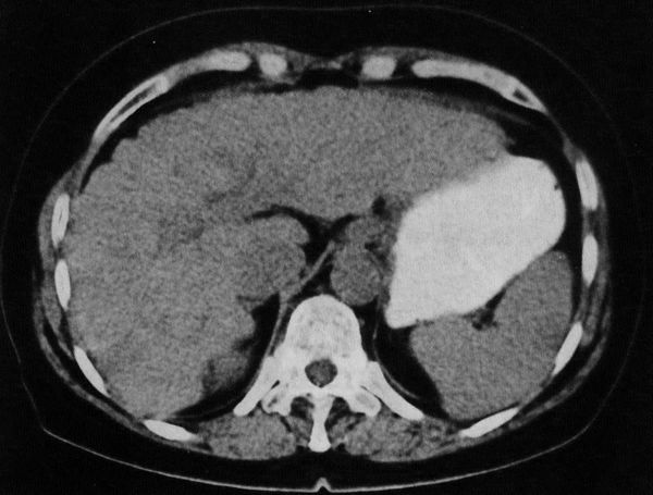 Компьютерная томограмма больного циррозом печени (фото)