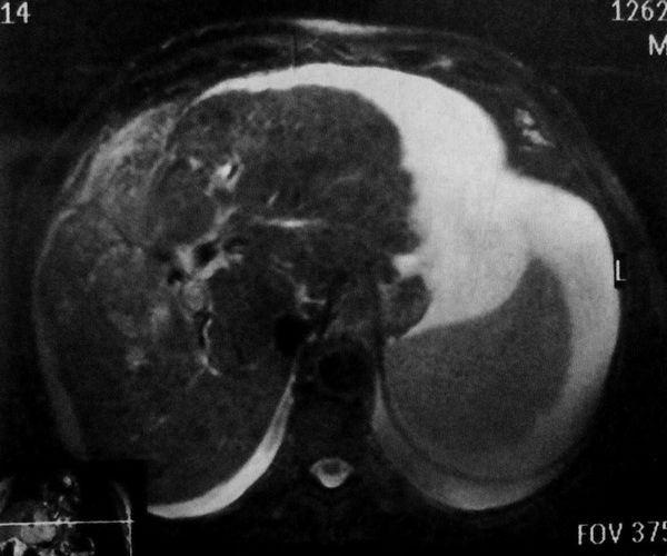 Цирроз печени на МРТ (фото)