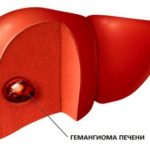 Опухоль печени — гемангиома (код по МКБ 10, УЗИ, КТ, МРТ)