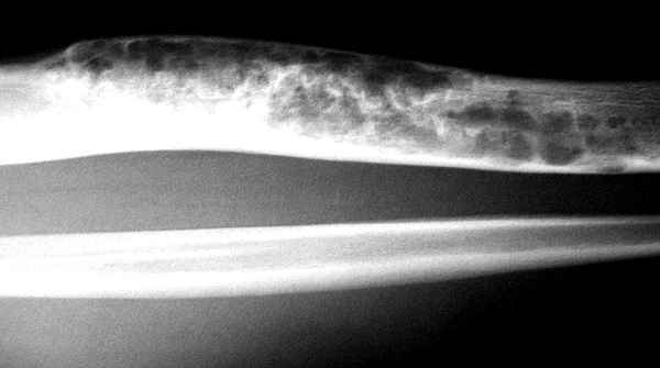 Адамантинома большеберцовой кости (фото рентгена)