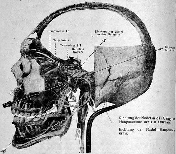 Блокада третьей пары тройничного нерва у foramen ovale