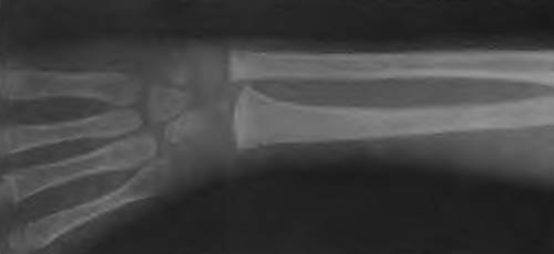 Аплазия 1 пястной кости (фото рентгенограммы)