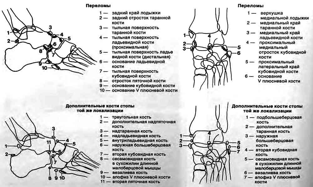 Дифференциальная диагностика между обычными отрывными переломами с добавочными косточками