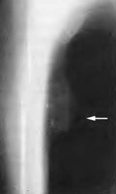 Доброкачественная остеохондрома грудины (фото)