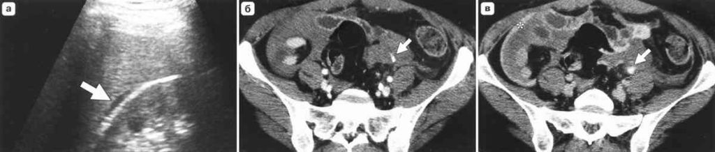 Травма брыжейки кишечника (компьютерная томография и УЗИ)
