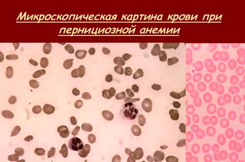 Кровь при пернициозной анемии