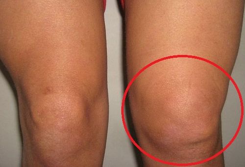 Гемартроз коленного сустава