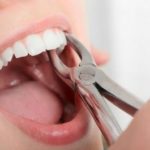 Удаление зубов: что нужно помнить