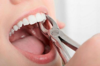 Удаление зубов: что нужно помнить