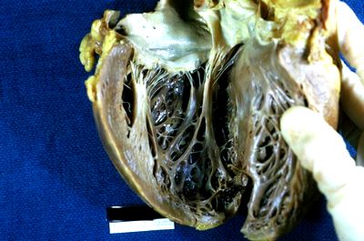 Сосочковые мышцы сердца